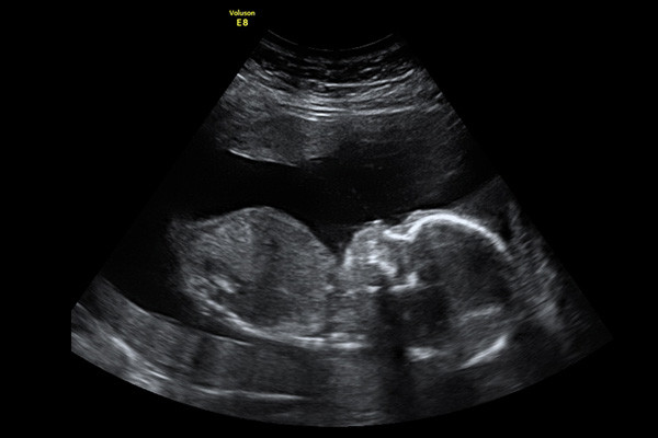 Early Pregnancy Scans at Hello Baby