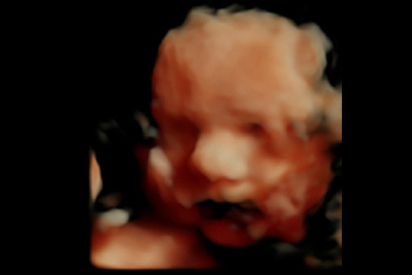 HD-Live Baby Scans St Helens