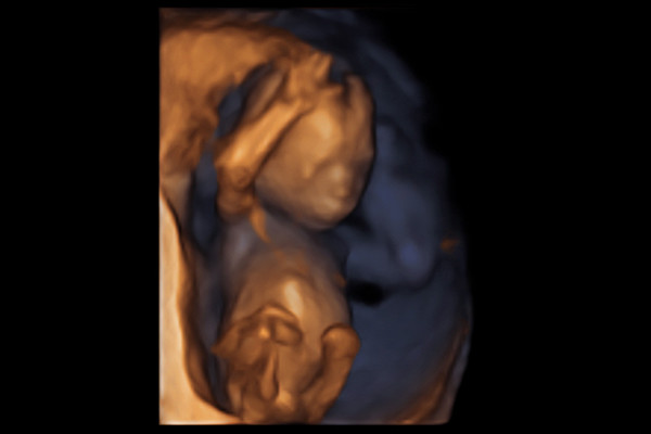 4D Scans at Hello Baby