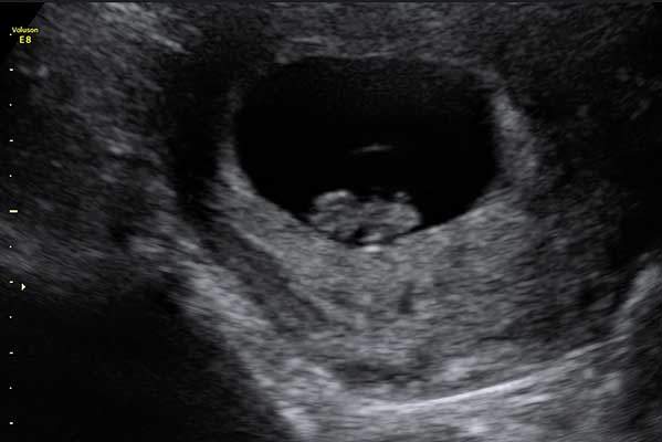 Early Pregnancy Scans at Hello Baby