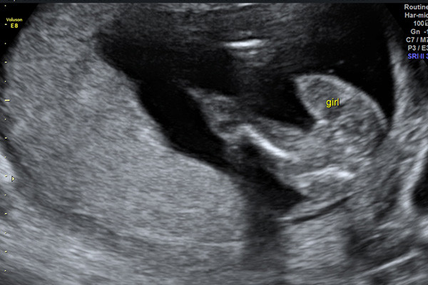 Private Ultrasound Scans St Helens - Hello Baby