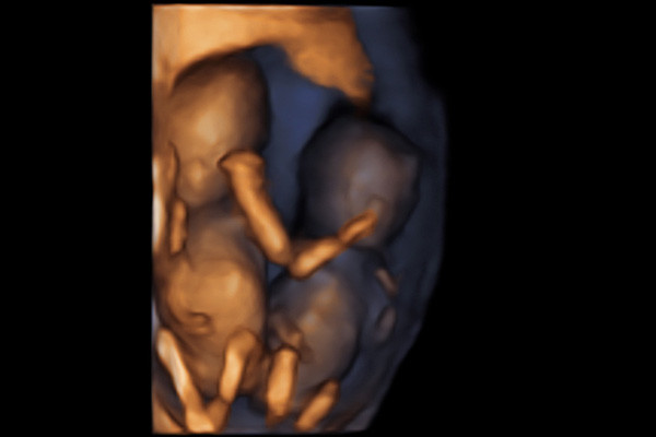 4D Scans at Hello Baby